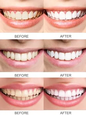 MySmile Teeth Whitening Kit with LED Light, Flagship 10 Min Non-Sensitive Max Teeth Whitener with Enhanced Carbamide Peroxide Teeth Whitening Pen, Helps to Remove Stains from Coffee, Smoking, Wine - teeth