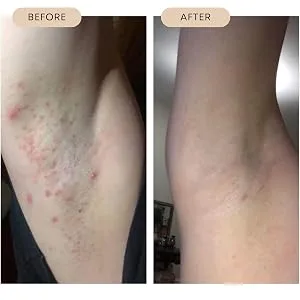 Bushbalm 2 Step Routine for Hyperpigmentation & Dark Spots - Bermuda Oil Dark Spot Treatment (30 ml) and Bermuda Dark Spot Exfoliating Scrub (236 ml) Dark Spots 2 Piece Set 2-Step Routine - exfoliating scrub for ingrown hair