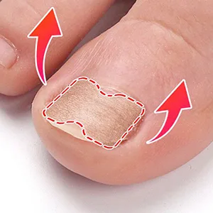 80 pcs toenail patch ingrown toenail correction sticker toenail correction patch corrector pedicure tools pedicure sticker toenail elastic patch - product information 4