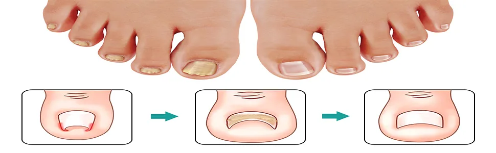 80 pcs toenail patch ingrown toenail correction sticker toenail correction patch corrector pedicure tools pedicure sticker toenail elastic patch - product information 5