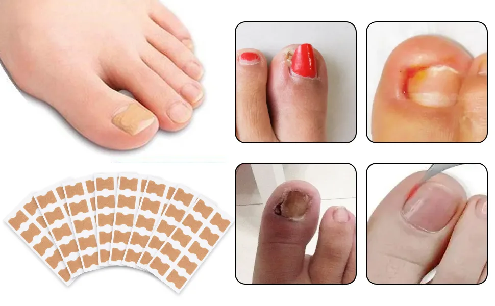 80 pcs toenail patch ingrown toenail correction sticker toenail correction patch corrector pedicure tools pedicure sticker toenail elastic patch - product information 6