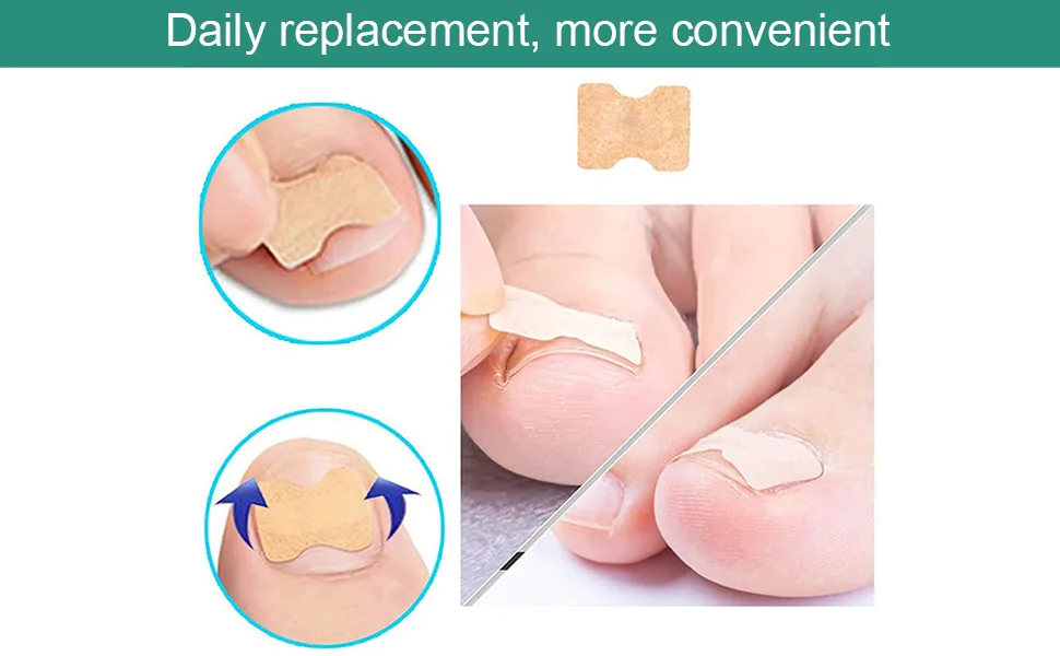 Toenail patch ingrown toenail correction patch toenail correction patch toenail correction patch corrector pedicure tools correction sticker toe nail 60 pcs - product information 6