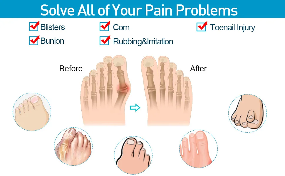 Sumiwish Flanged Toe Spacer 12 Pack Bunion Corrector (mixed size) silicone toe separator to combat bunion overlapping toes |Size L&S - The better choice 01 Clear - T0154