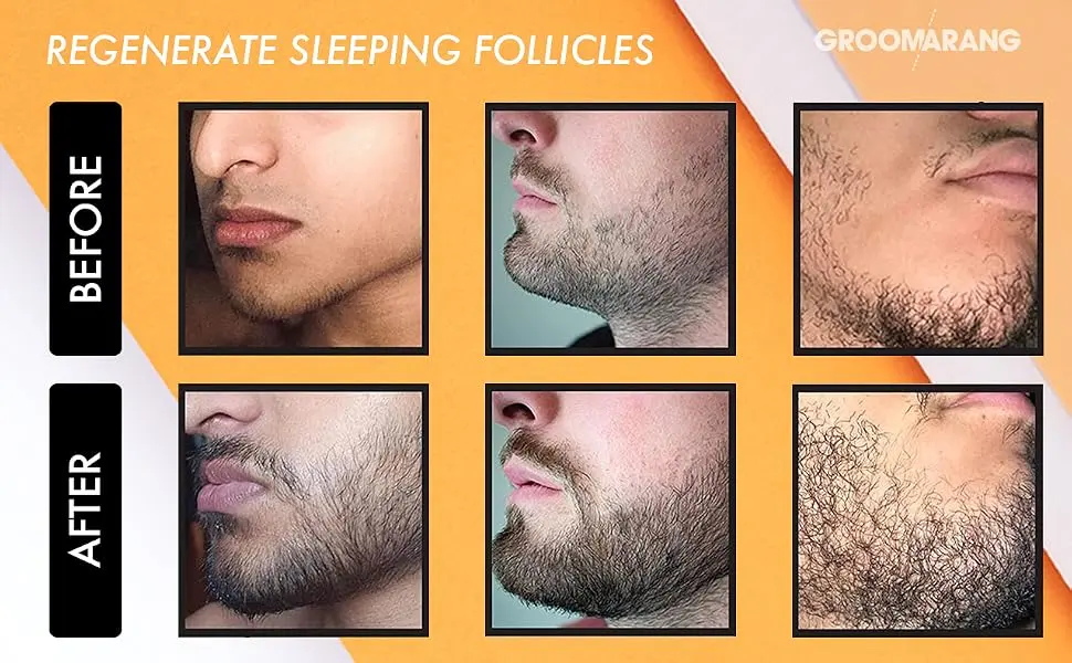 Groomarang bar scooters for men 0.5 mm dermar roller for beard growth with 540 titanium needles suitable for face and scalp including storage case - Vor und nach.