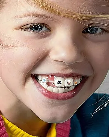 Invisalign Case For Clear Aligners With Precision Wings Mandibular - Invisalign