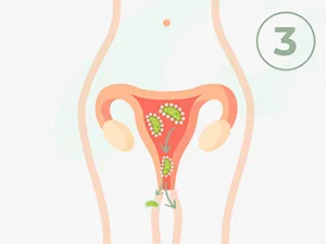 N1 D -Mannose Direct sticks 60 St. - Super -Spar package - for bladder infection & urinary tract infection - 60 days - without antibiotics - without water - delicious taste 30 pieces (2 pack) - n1 d-mannose