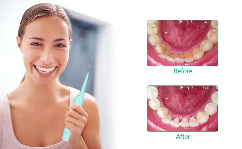 Electric Dental Calculus Remover, Sonic Tooth Scraper Plaque Tartar Stain Remover for Teeth High Frequency Vibration Teeth Cleaning Tools Kit with LED USB Rechargeable 3 Modes 2 Cleaning Heads (Blue) - product information 4