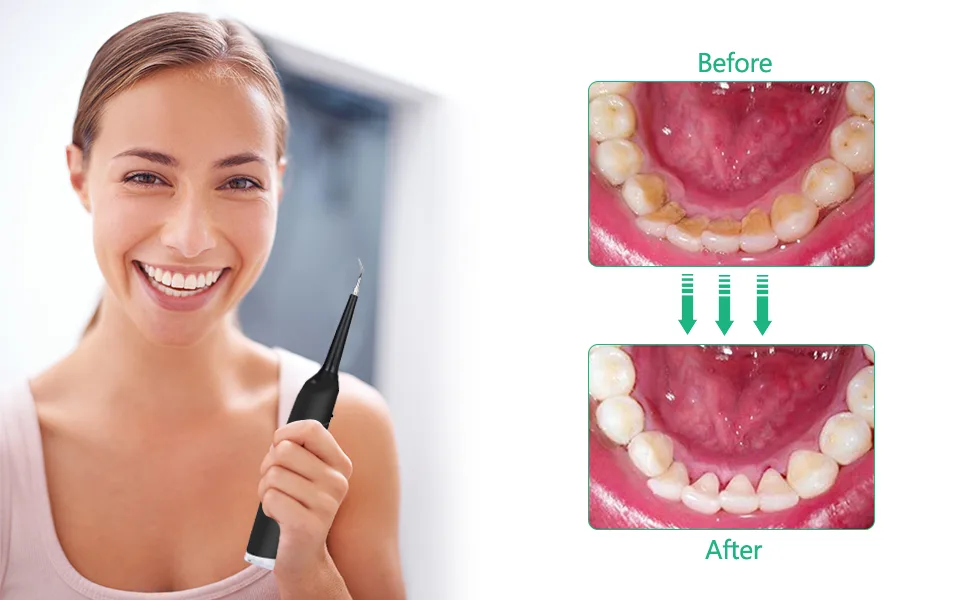 Electric Dental Calculus Remover, Plaque Remover for Teeth Tartar Stain Remover, High Frequency Sonic Tooth Cleaner Scraper Teeth Cleaning Kit with LED Light USB Rechargeable 3 Adjustable Modes Black - product information 3