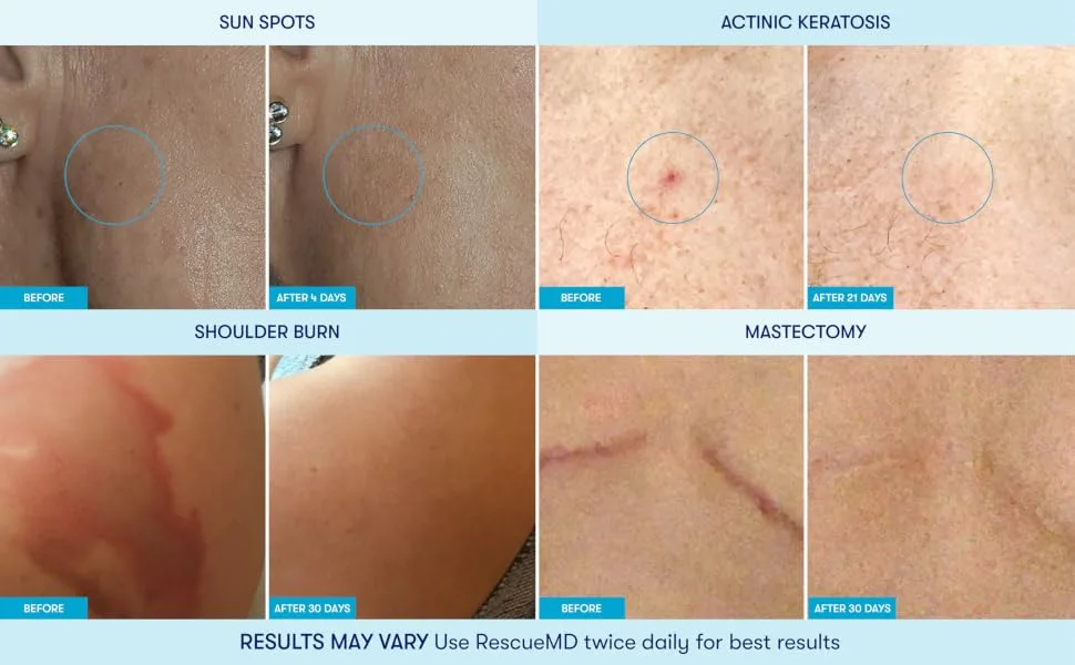 RescueMD DNA Repair Complex Scar Treatment Serum, Post-Procedure and Skin Damage Solution, 15mL - before after