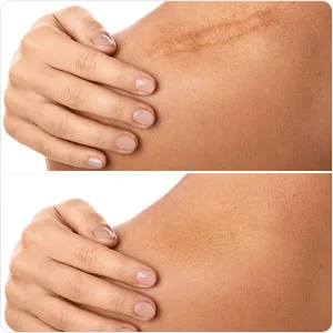 Scar Remover Gel for Scars from C-Section, Stretch Marks, Acne, Surgery, Effective for both Old and New Scars (30g) 1.05 Ounce (Pack of 1) - product information 5