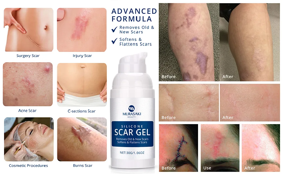 Scar Gel silicone scar gel from C-Section, Stretch Marks, Acne, Surgery, Effective for both Old and New Scars White - product information 4