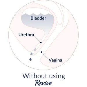 Revive Reusable Bladder Support for Women, One Size Fits Most, Works for Stress Urinary Incontinence (Light Bladder Leaks); Not Urge Incontinence - Medical illustration demonstrating how Revive works to stop light bladder leaks.