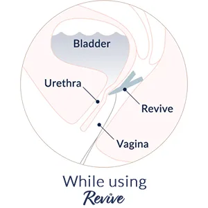 Revive Reusable Bladder Support for Women, One Size Fits Most, Works for Stress Urinary Incontinence (Light Bladder Leaks); Not Urge Incontinence - Revive uses gentle pressure to support the urethra and prevent stress incontinence.