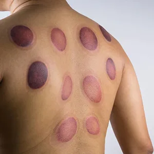 24 Cupping Set,Chinese Professional Cupping Therapy Set - 24 Cupping Set,Chinese Professional Cupping Therapy Set