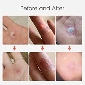 MYMULIKE Corn Removal Pads, Wart Remover, Corn Removal Plaster, Corn Removal Relief Corn Pain and Foot Care (24 Count) 24 Count (Pack of 1) - corn removal corn treatment foot corn removal foot corn treatment corn remover products toe removal
