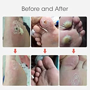 MYMULIKE Corn Removal Pads, Wart Remover, Corn Removal Plaster, Corn Removal Relief Corn Pain and Foot Care (24 Count) 24 Count (Pack of 1) - corn removal corn treatment foot corn removal foot corn treatment corn remover products toe removal