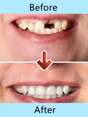 Tooth Repair Kit Temporary Tooth Repair Kit Temporary Tooth Repair Beads for Missing Broken Teeth Dental Tooth Filling Material(100g) - product information 3