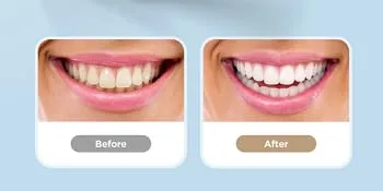 Teeth Whitening Strips for Teeth Sensitive  Reduced Sensitivity White Strips for Teeth Whitening  Dental Teeth Whitening Kit Pack of 28 Whitener Strips (14 Treatments) Mint - tooth
