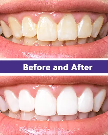 Hot Pepper Natural Purple Toothpaste for Teeth Whitening Color Corrector Purple Toothpaste Brighten Your Smile Gently 30ml - purple toothpaste