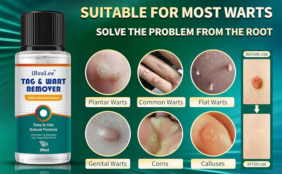 Wart Remover Liquid - Effective Wart Removal with Specialized Formula for Plantar and Common Warts. Safe Botanical-Based and Strong - skin tag removal kit