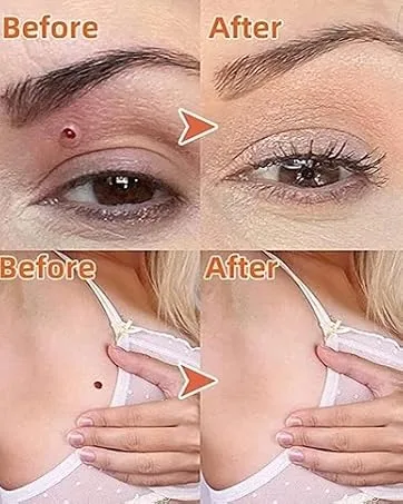 Wart Remover Liquid - Effective Wart Removal with Specialized Formula for Plantar and Common Warts. Safe Botanical-Based and Strong - skin tags removal