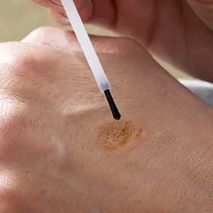 Wart Remover Liquid - Effective Wart Removal with Specialized Formula for Plantar and Common Warts. Safe Botanical-Based and Strong - skin tags remover
