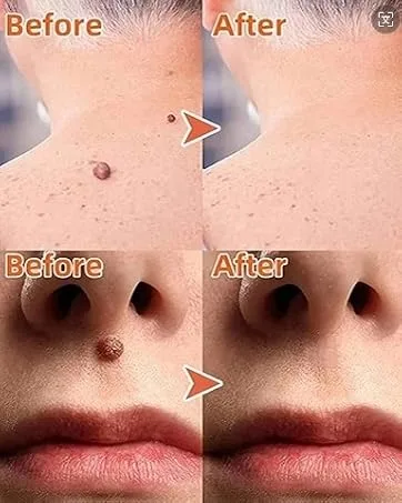 Wart Remover Liquid - Effective Wart Removal with Specialized Formula for Plantar and Common Warts. Safe Botanical-Based and Strong - skin tags remover