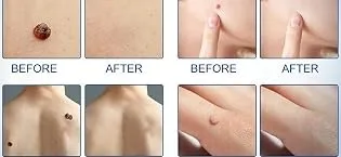 Wart Remover Liquid - Effective Wart Removal with Specialized Formula for Plantar and Common Warts. Safe Botanical-Based and Strong - wart remover