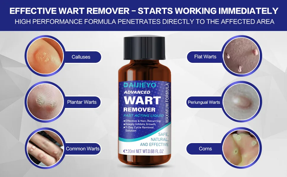 Wart Remover Liquid - Maximum Strength Formula for Rapidly Removing Plantar Warts and Common Warts Safe Natural & Potent Suitable for Most Body Warts - corn removers for toes
