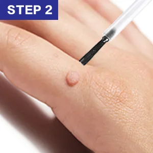 Wart Remover Liquid - Maximum Strength Formula for Rapidly Removing Plantar Warts and Common Warts Safe Natural & Potent Suitable for Most Body Warts - plantar wart remover