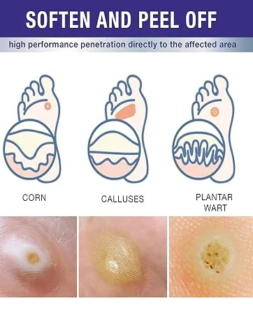 Wart Remover Liquid - Maximum Strength Formula for Rapidly Removing Plantar Warts and Common Warts Safe Natural & Potent Suitable for Most Body Warts - wart remover