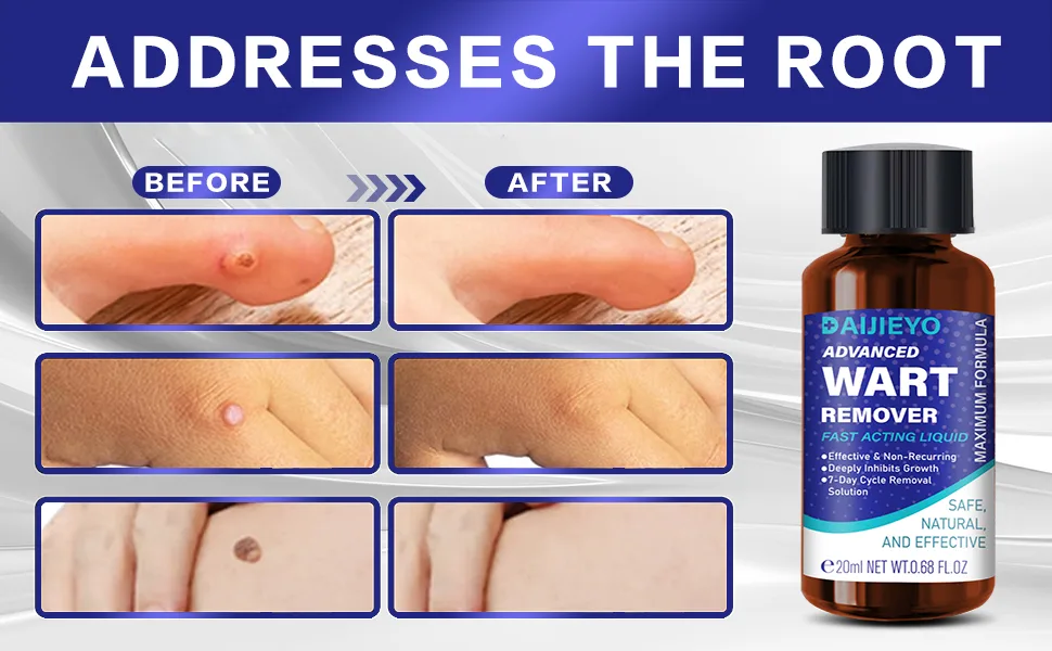 Wart Remover Liquid - Maximum Strength Formula for Rapidly Removing Plantar Warts and Common Warts Safe Natural & Potent Suitable for Most Body Warts - wart remover bandaid