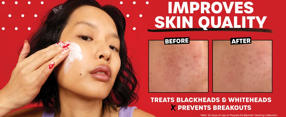 Thayers Blemish Clearing Salicylic Acid and Witch Hazel Acne Face Moisturizer 4 fl oz - thayers skin quality