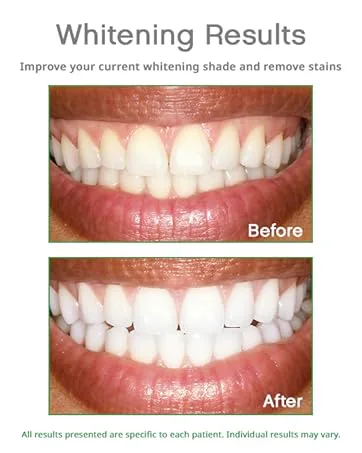 Opalescence Whitening Toothpaste 4.7oz - Teeth Before and After Opalescence