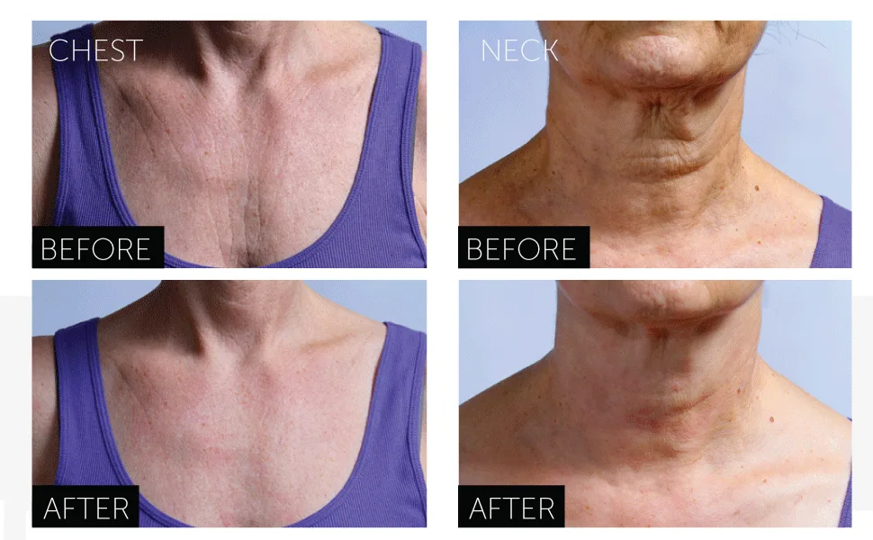 SilcSkin Complete Chest Care Includes 1 Reusable Decollette Pad and 1 Bottle SilcSkin Cleanser - Helps with Wrinkles from Sun Aging Side Sleeping - Gentle Water Based Cleansing Formula - chest, neck, pad, anti wrinkle, decollette, smooth skin, soft, wrinkles, silicone, reusable