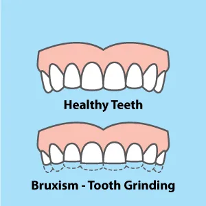 SleepRight ProRx Custom Fit Dental Guard - Helps with Teeth Grinding, Clenching and Bruxism - Provides Maximum Protection - healthy teeth, bruxism, teeth grinding, grinding