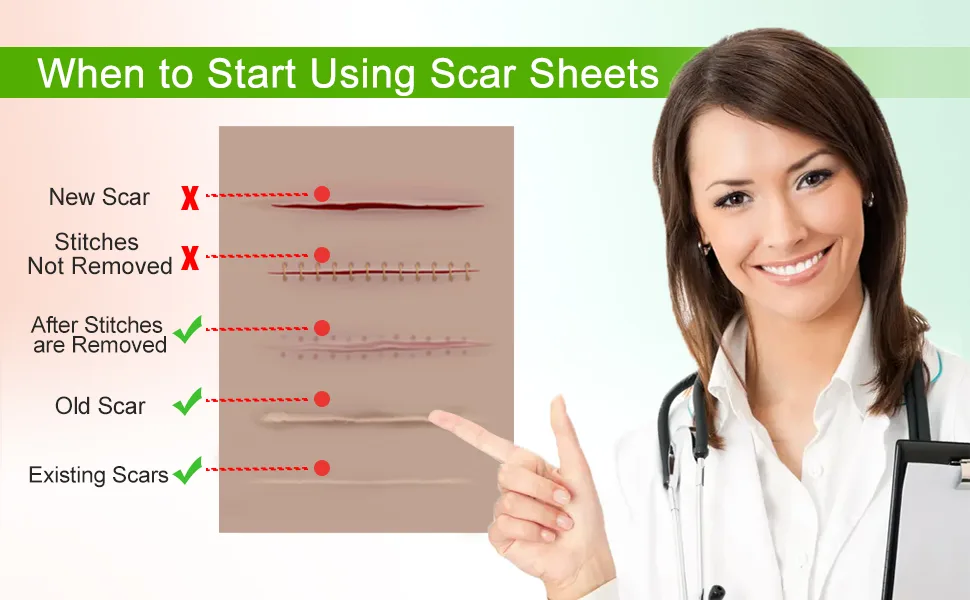 Silicone Scar Sheets (1.6 x 120Roll-3M), Silicone Scar Tape Roll, Scar Silicone Strips, Reusable, Professional Scar Removal Sheets for C-Section, Surgery, Burn, Keloid, Acne et - 1.55