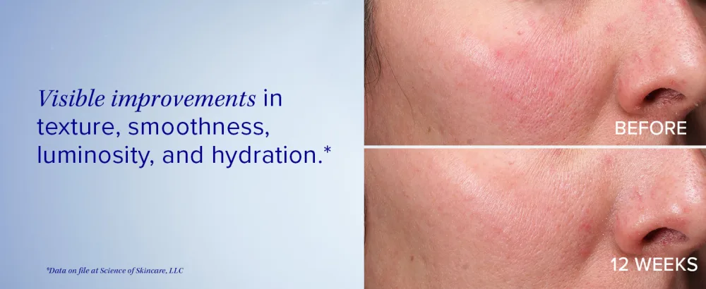 iS Clinical Retinol+ Emulsion 0.3 reduce fine lines and wrinkles smooths appearance helps brighten complexion - before after 12 weeks visible improvement texture smoothness luminosity hydration