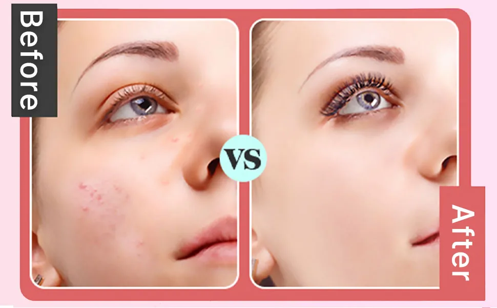 Facial Cleansing Brush for Blackheads Whiteheads Makeup Residues Removal - product information 7
