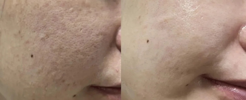NUBORN CELL Zzirit Face Mask - Zzirit Mask Before and After
