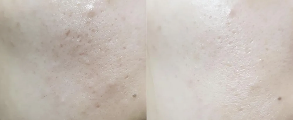 NUBORN CELL Zzirit Face Mask - Zzirit Mask Before and After 3