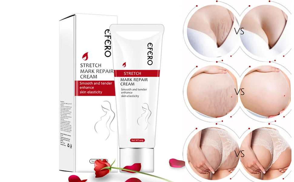 Stretch Marks Removal Cream Women Bad Sign Pregnancy Marks Acne Marks Remove Moisturizing Firming Body Skin - product information 1