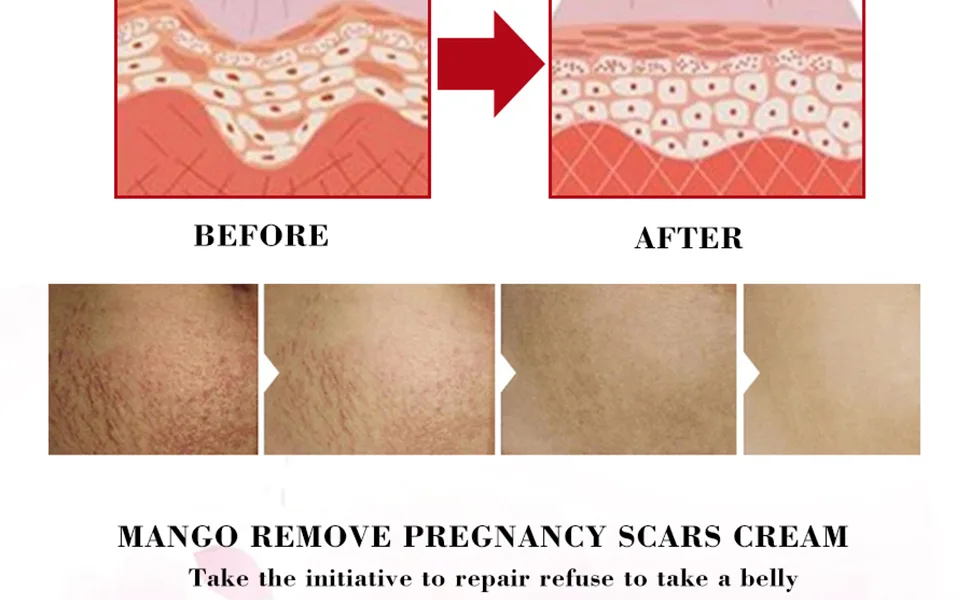 Stretch Marks Removal Cream Women Bad Sign Pregnancy Marks Acne Marks Remove Moisturizing Firming Body Skin - product information 4