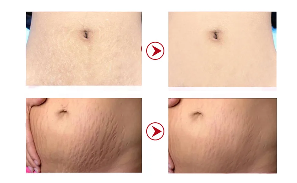 Stretch Marks Removal Cream Women Bad Sign Pregnancy Marks Acne Marks Remove Moisturizing Firming Body Skin - product information 5