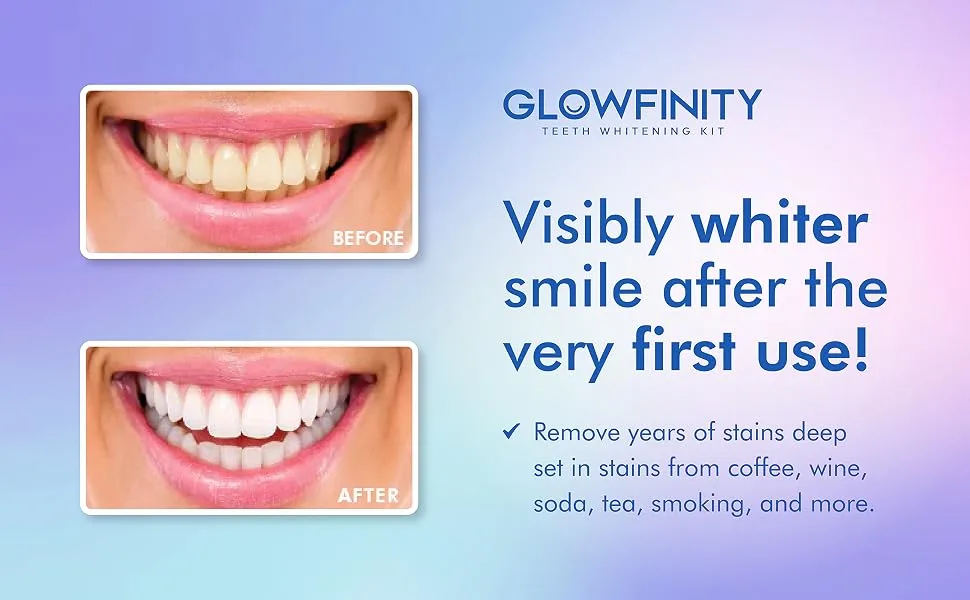 Teeth Whitening Kit - LED Light 35% Carbamide Peroxide (3) 3ml Gel Syringes (1) Remineralization Gel and Tray - white tooth light purple toothpaste powder trays whiting stripes carbamide