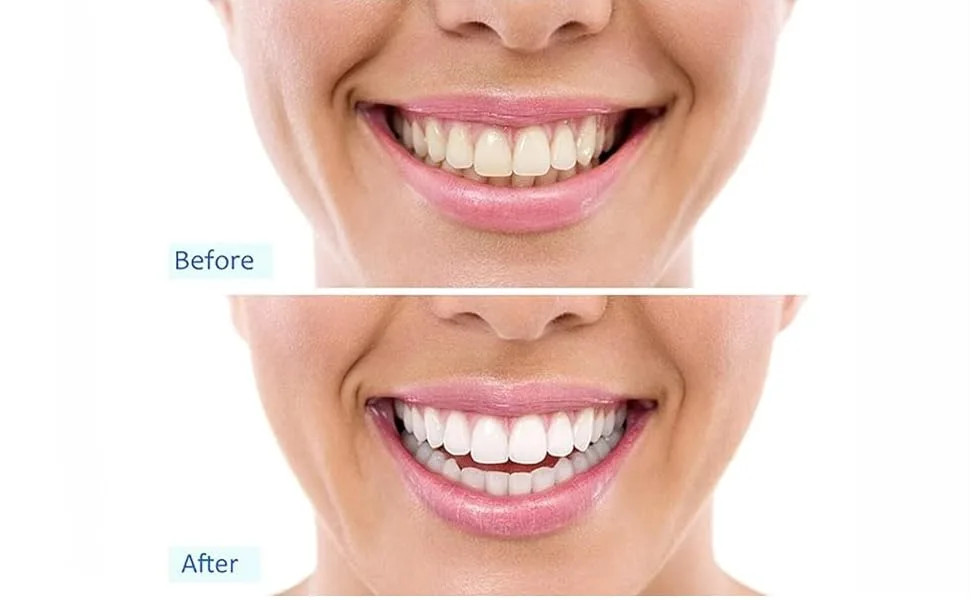 32 LED Teeth Whitening Accelerator Light with Cold Light &Red Lights Trays Device Teeth Whitening Enhancer Light Built-in 16 Minute Timer (White) - Fast Teeth Whitening