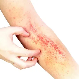 Eczema Treatment Cream with 1% Hydrocortisone and 0.5% Nifedipine 3.40 Ounce Eczema Therapy - ????