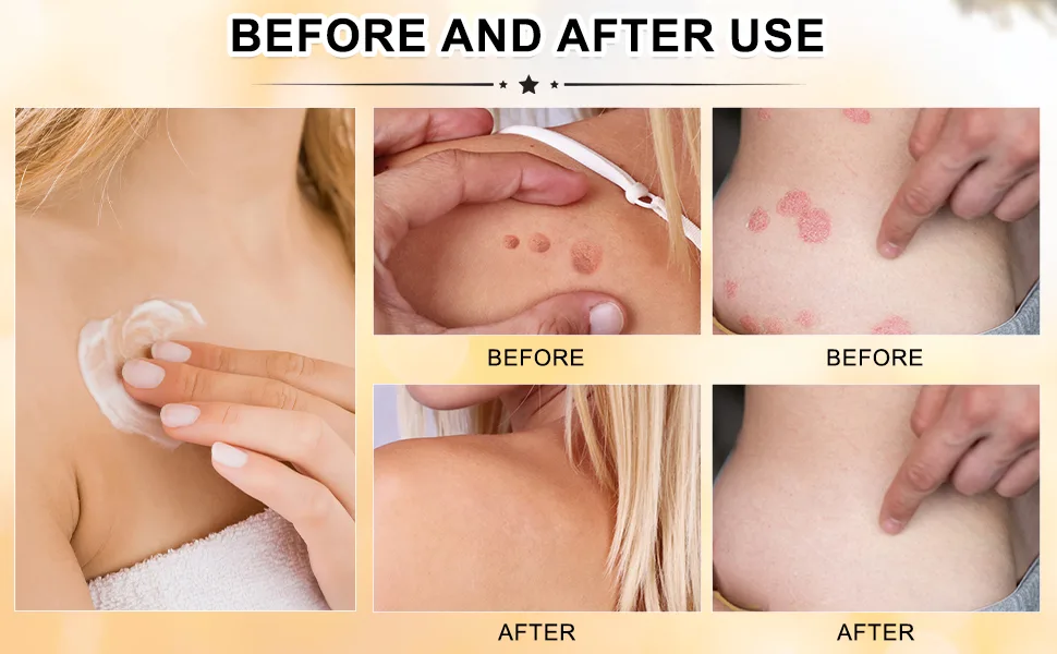 3 Bottle Bee Venom Cream New Bee Venom Skin Cream Professional Bee Venom Correcting Cream for All Skin Types - BEE VENOM