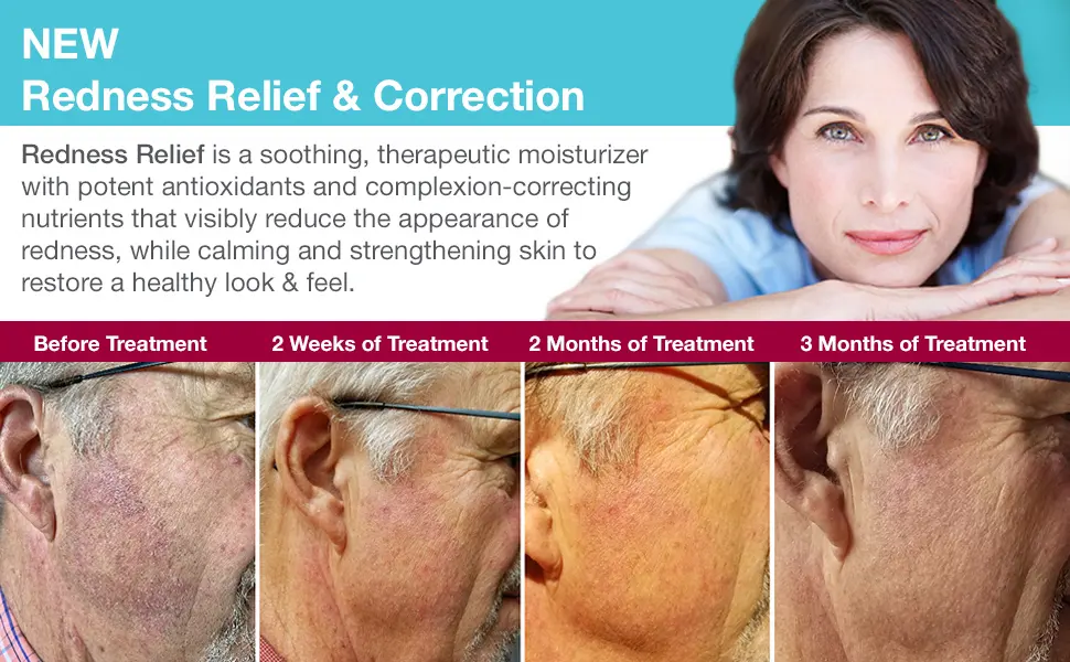 MD Complete Redness Relief Sensitive Skin Care Therapeutic Antioxidant Moisturizer with Vitamin C + Calming Natural Extracts 1.0 fl oz - Amazon_A+Content_Red_image1_0921