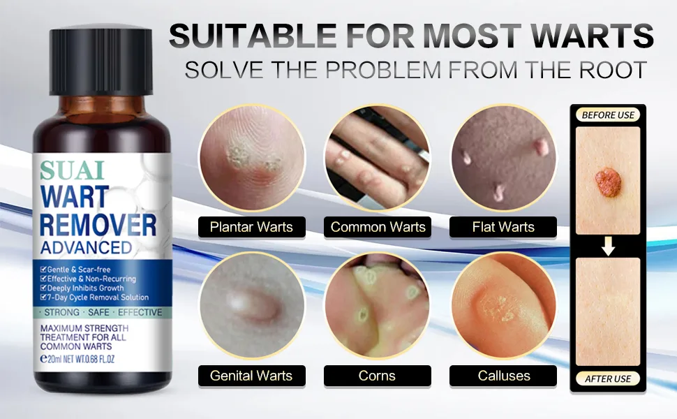 Aimery Wart Remover Liquid - Gentle Formula for Plantar Common and Flat Warts. Safe and Botanical-Based Solution - plantar wart remover for feet